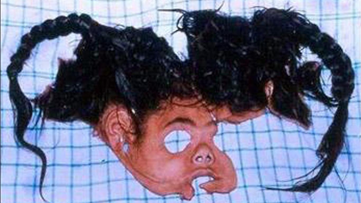 Human Face Transplant
