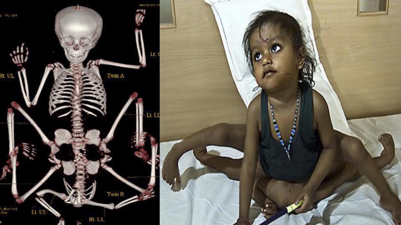 Girl with Eight Limbs