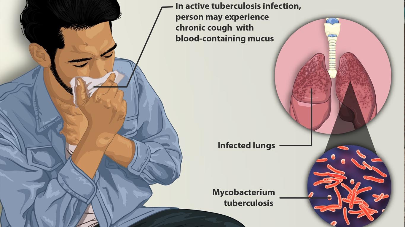 Tuberculosis Campaign